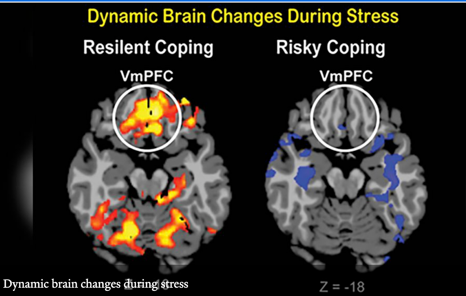 Dynamic brain changes during stress — resilient vs risky coping